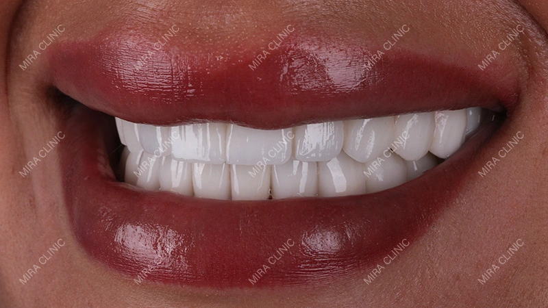 bite adjustment